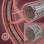 Aortic Stent Grafts Market 2024-2035: Growth, Trends, Regional Analysis & Key Players